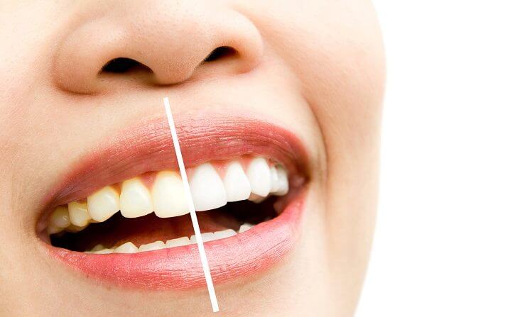 teeth stains