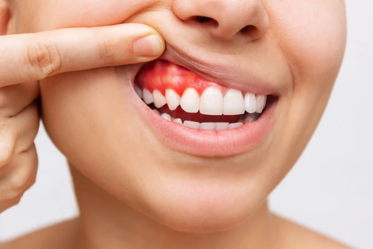 a girl showing receding gums bleeding and inflamation
