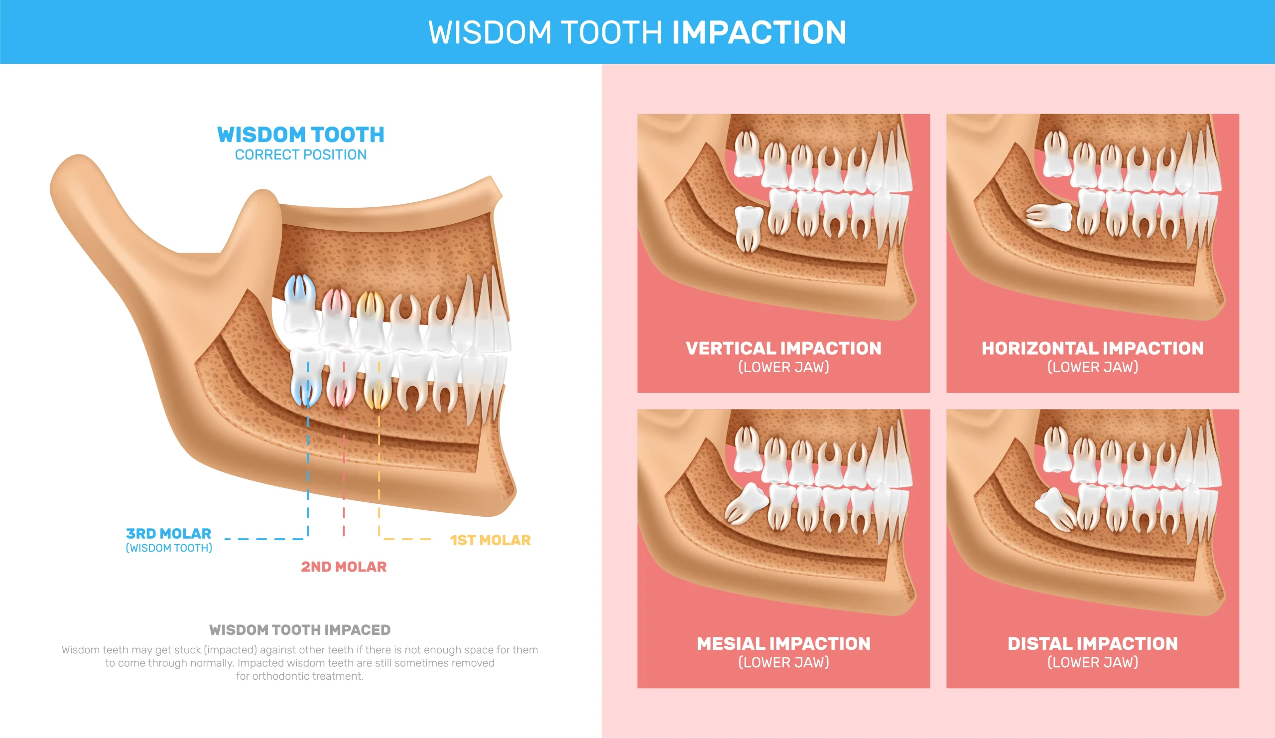 Impacted wisdom tooth