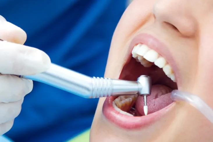 Dental Polishing