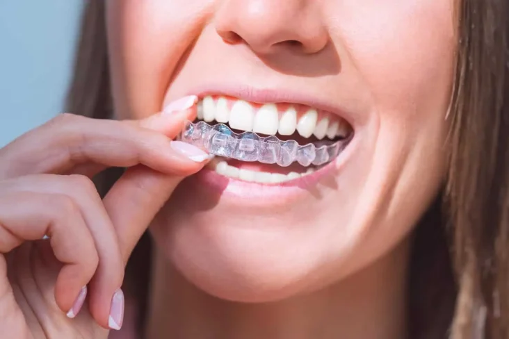 A woman wearing Retainers
