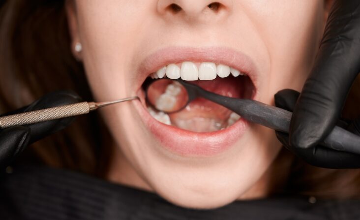 Dental Tartar