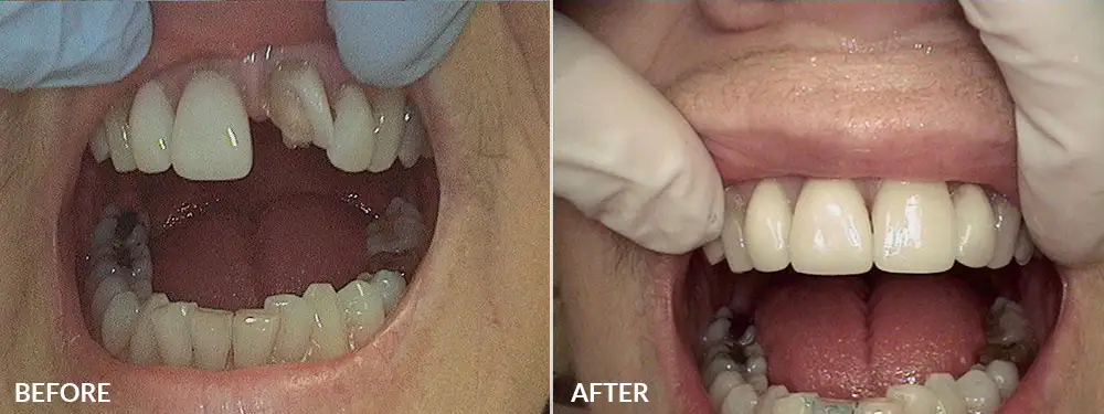 Veneers and Crowns