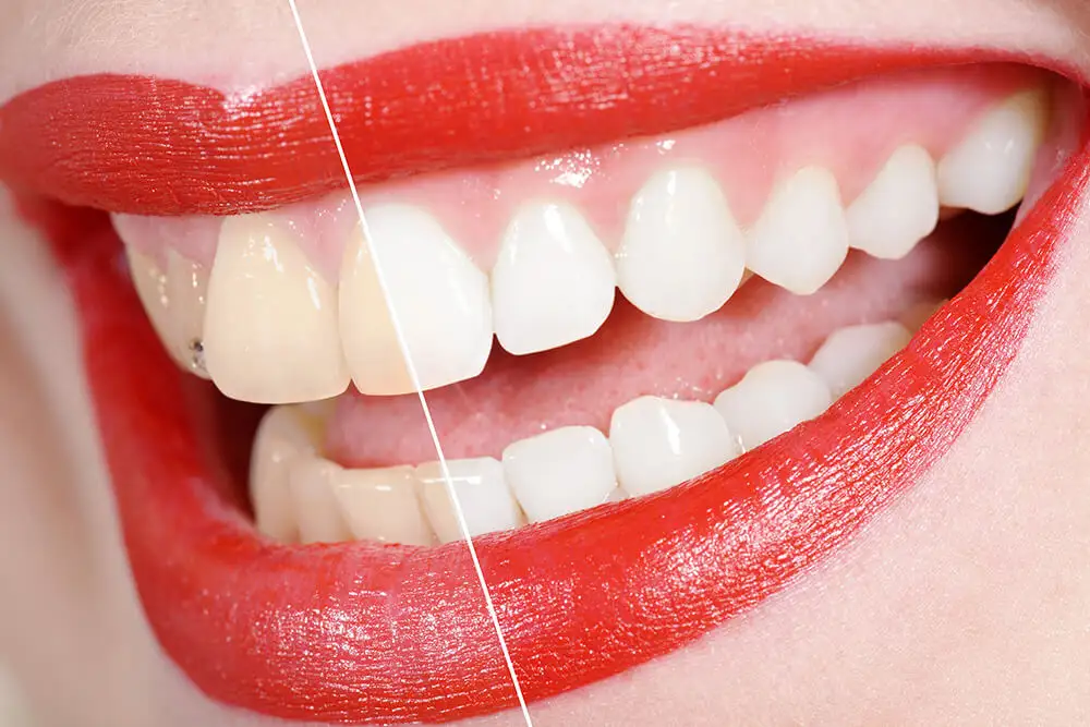 Teeth whitening before and after