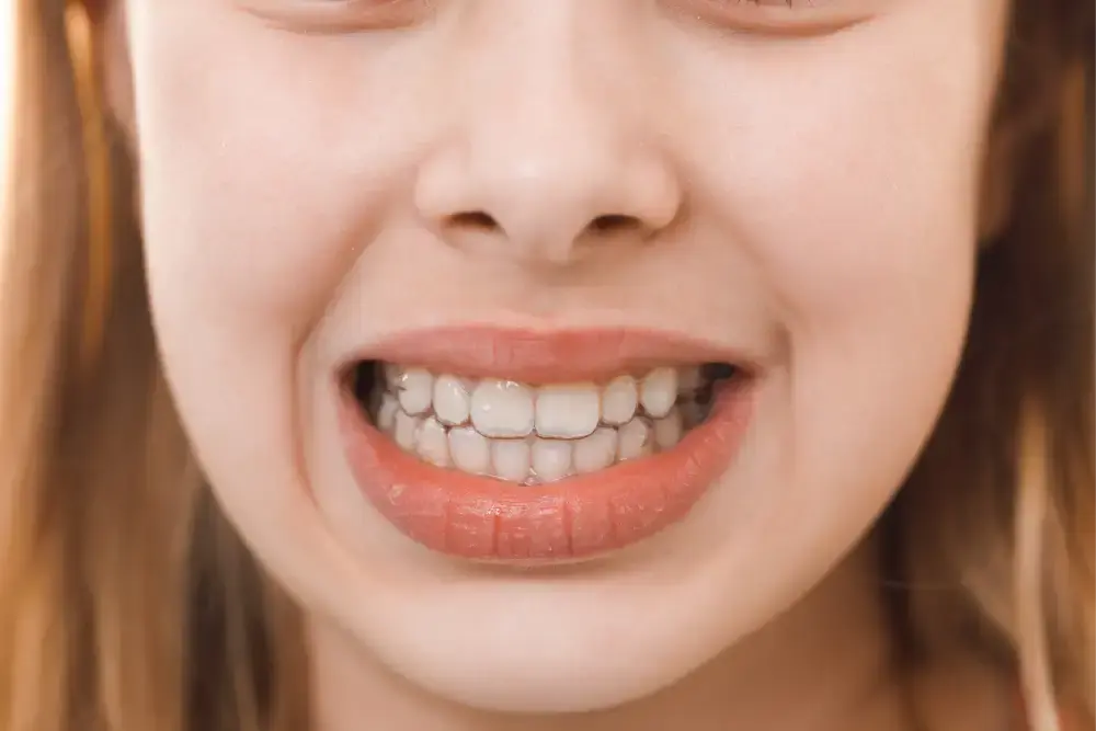 Protruding Teeth