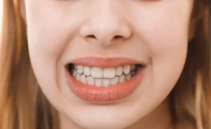 Protruding Teeth
