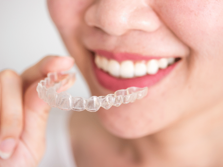 Can Invisalign Fix an Underbite